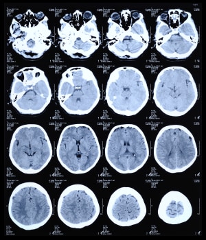 CT scan of the human brain.